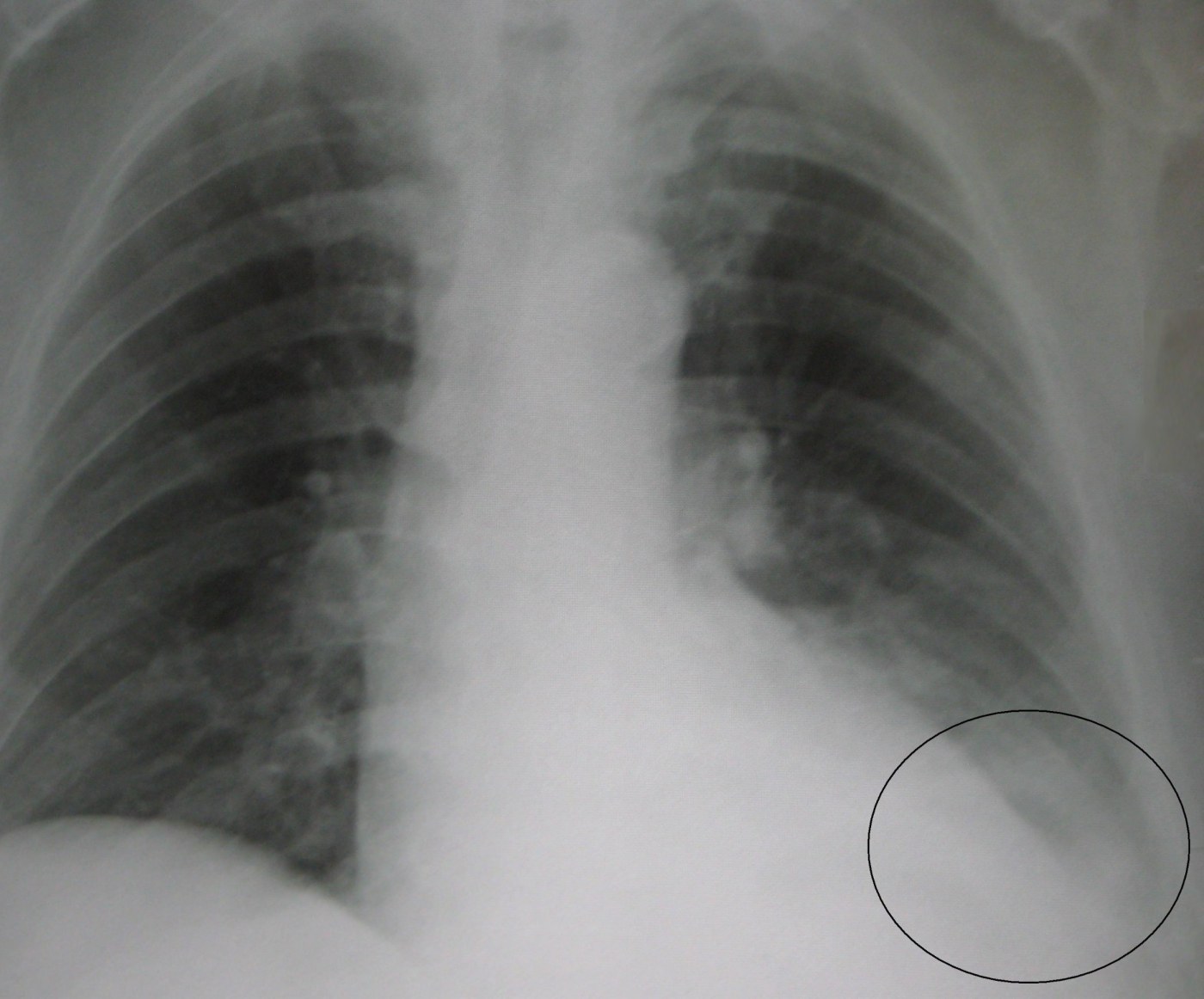 Photographed chest radiograph with a ring around the lower left lung zone and an example label