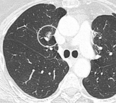 Axial chest CT in lung window with a lung nodule circled and labeled